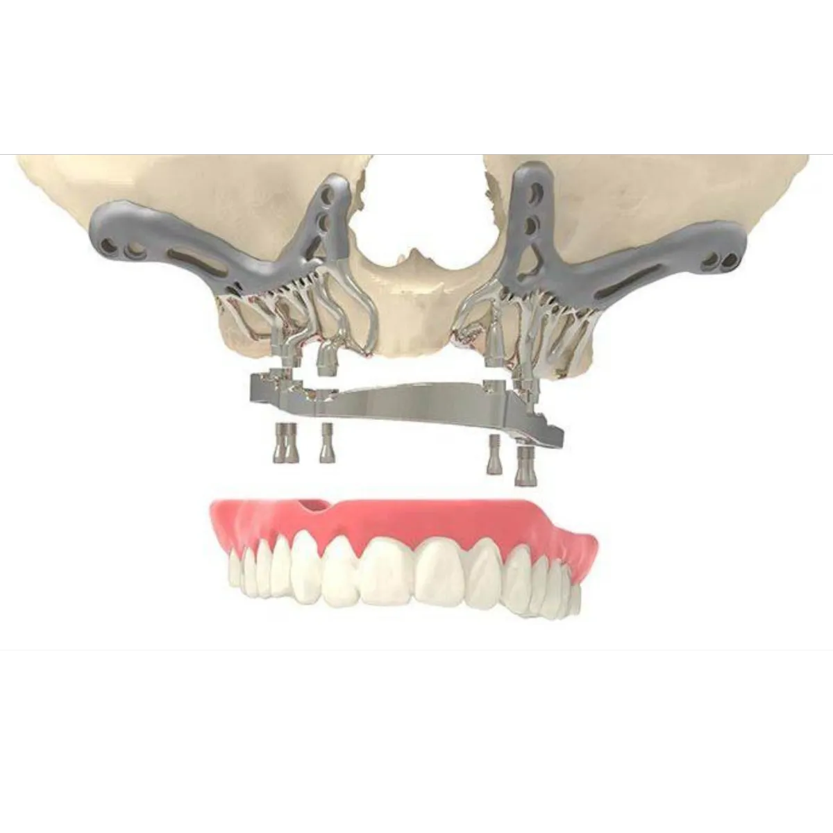 Subperiosteal Implants IMAGE