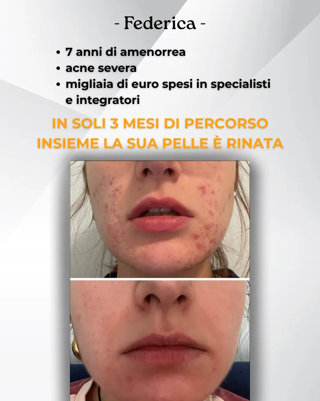 pcos amenorrea acne