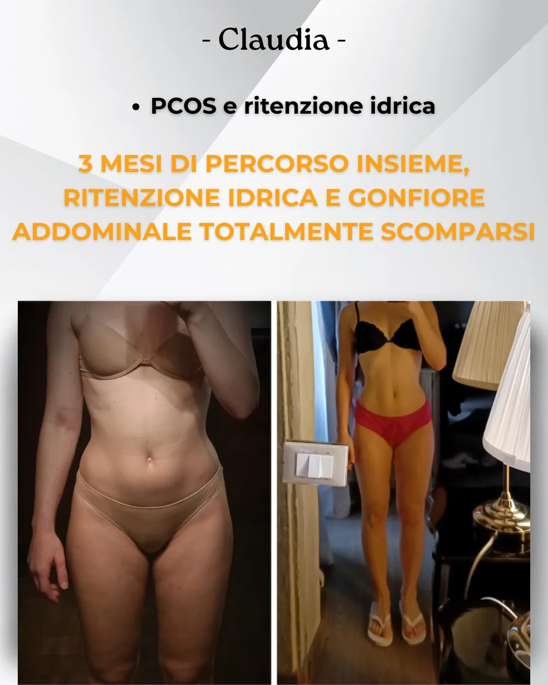 pcos amenorrea acne