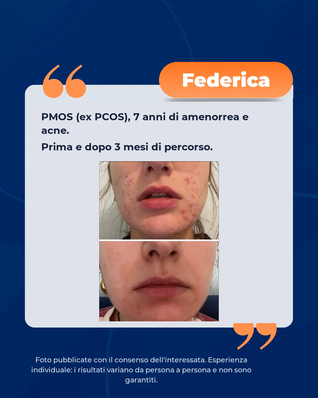 pcos amenorrea acne