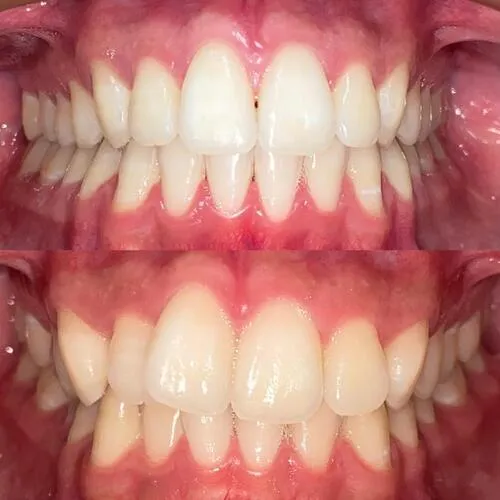 ortodoncia invisible antes y despues 1