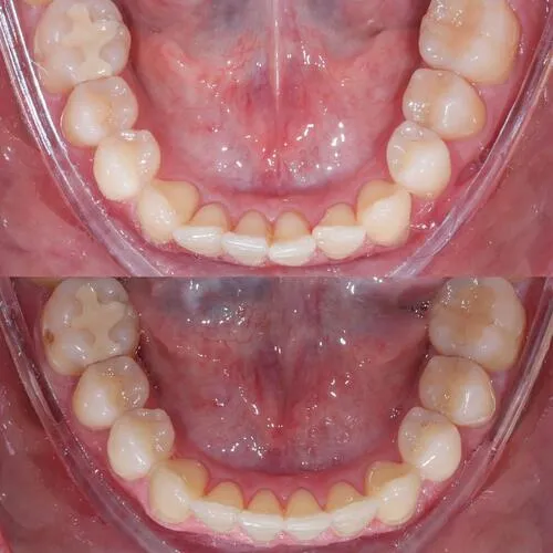 ortodoncia invisible antes y despues 3