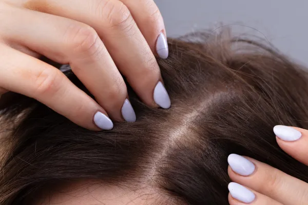 Female Pattern Hair Loss: What Every Woman Should Know
