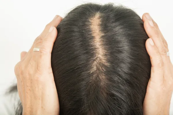 Hair Toppers for Perimenopause Crown Thinning
