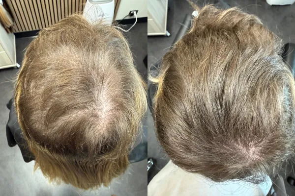 Trichotillomania Regrowth: What Affects Whether Hair Comes Back