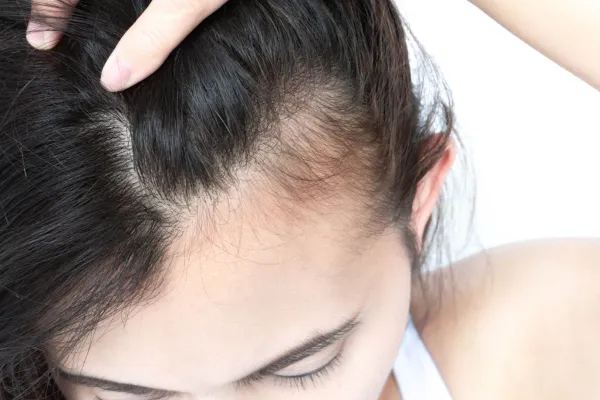 What Causes Traction Alopecia? Signs, Habits & What to Change