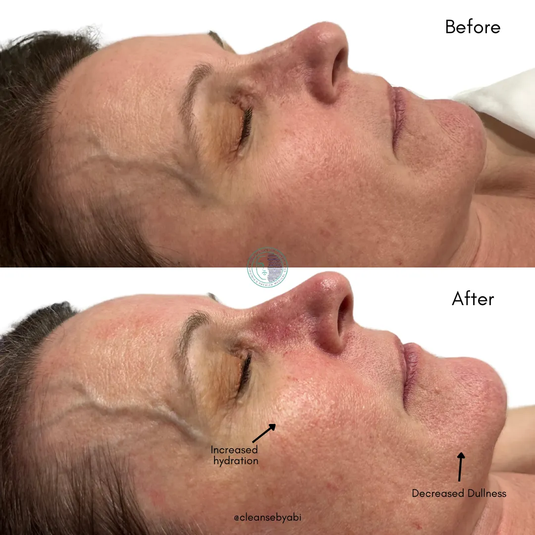 European Facial Before and after