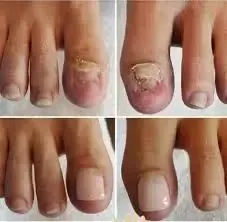 nail fungus treatment