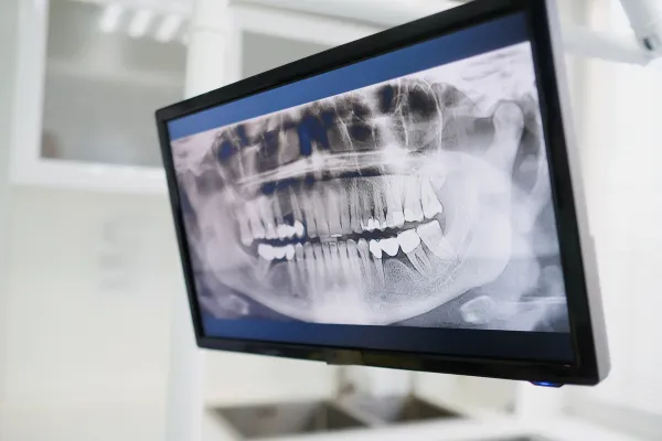 Problems arise when you put off getting dental implants for too long in Grand Junction