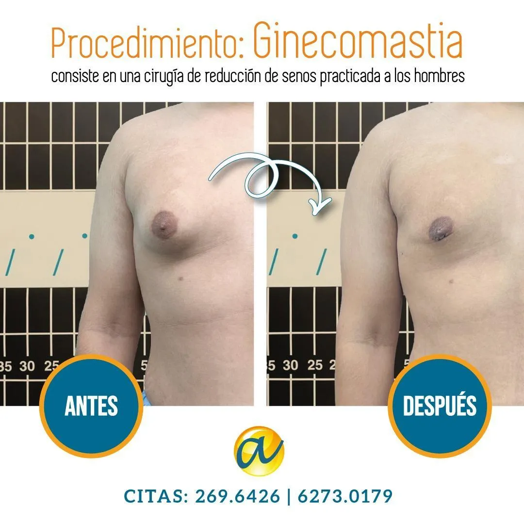 Paciente masculino antes y después de corrección de ginecomastia