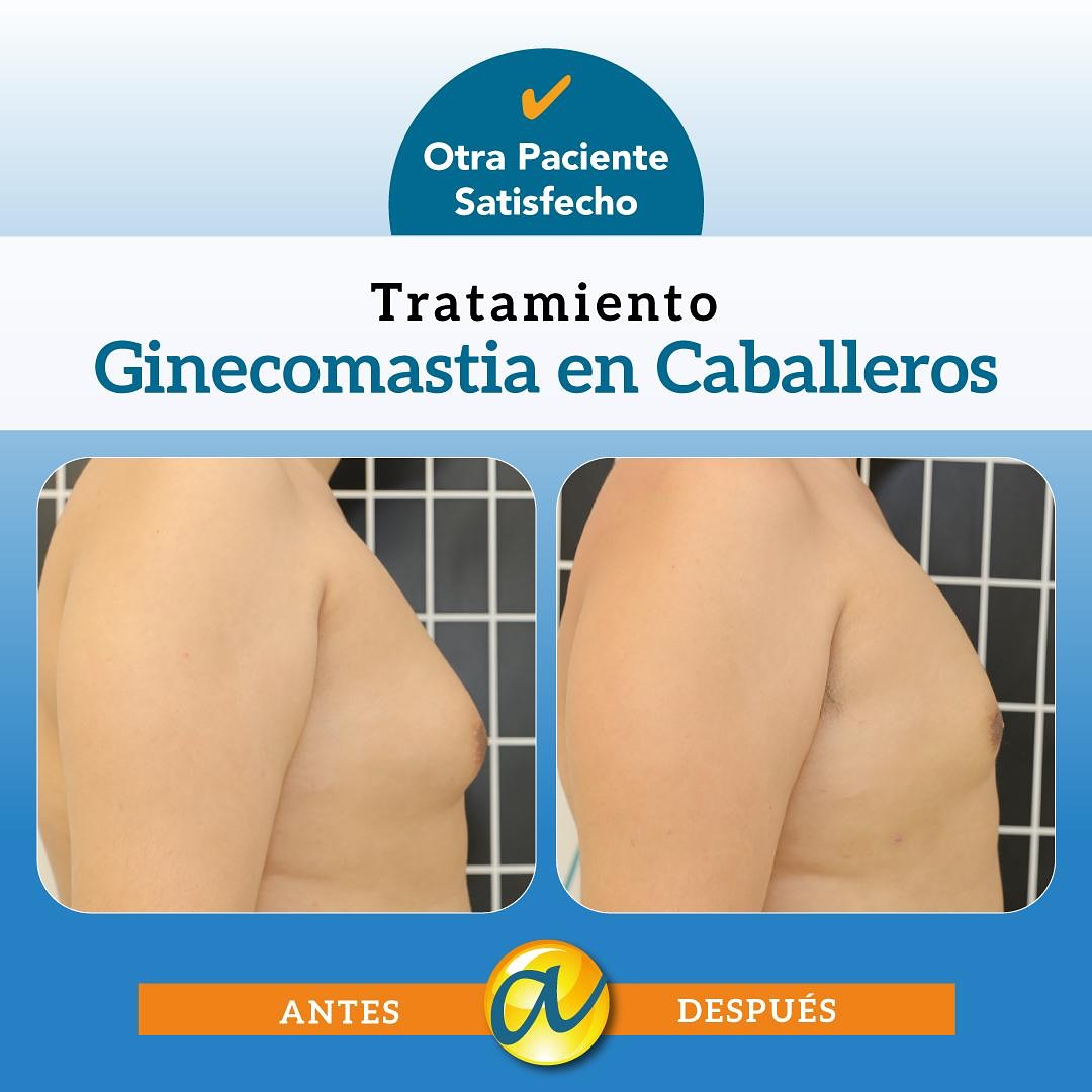 Resultados antes y después de ginecomastia