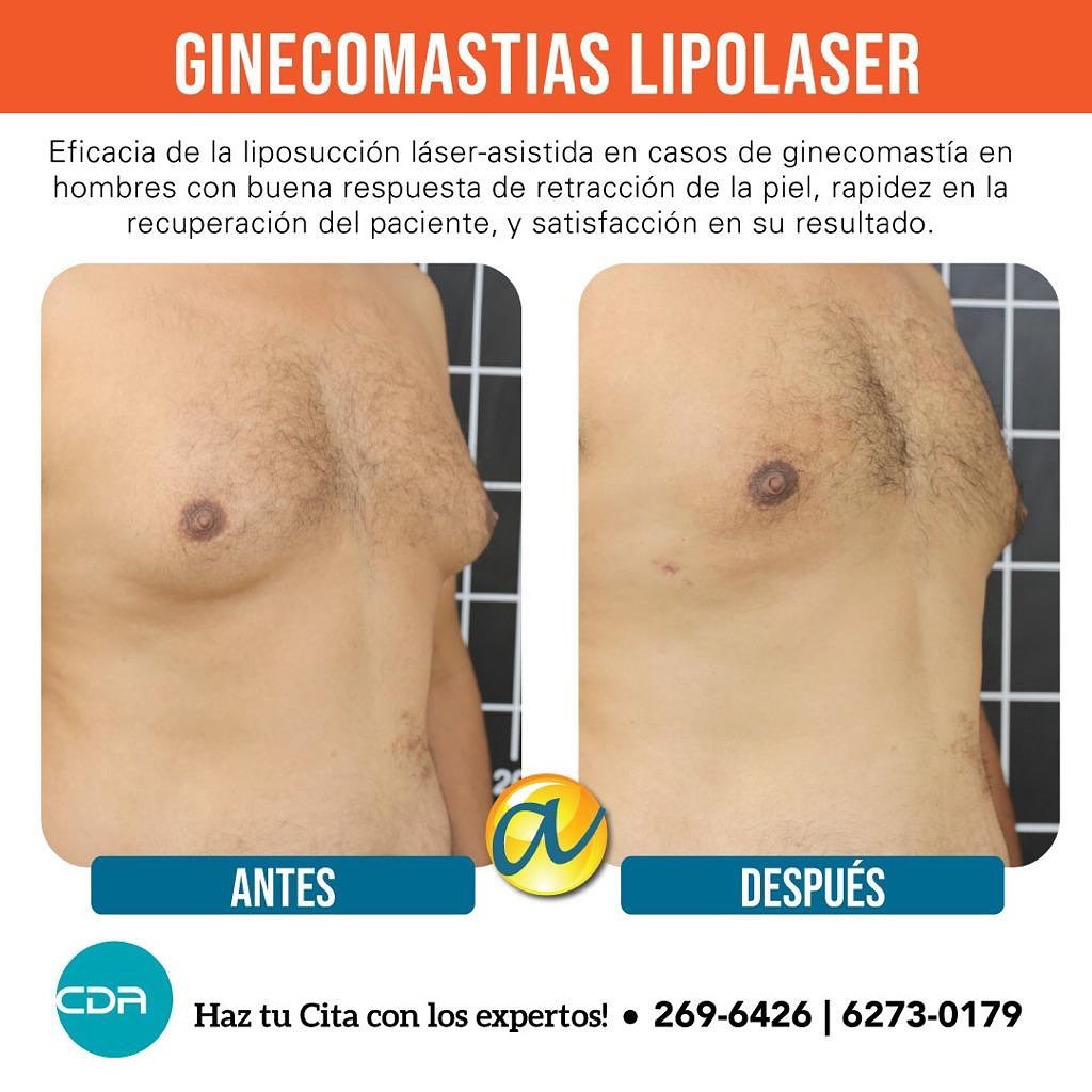 Resultados antes y después de ginecomastia