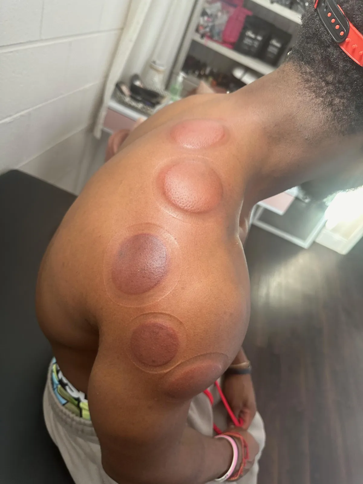 Shoulder after cupping therapy for pain relief and recovery