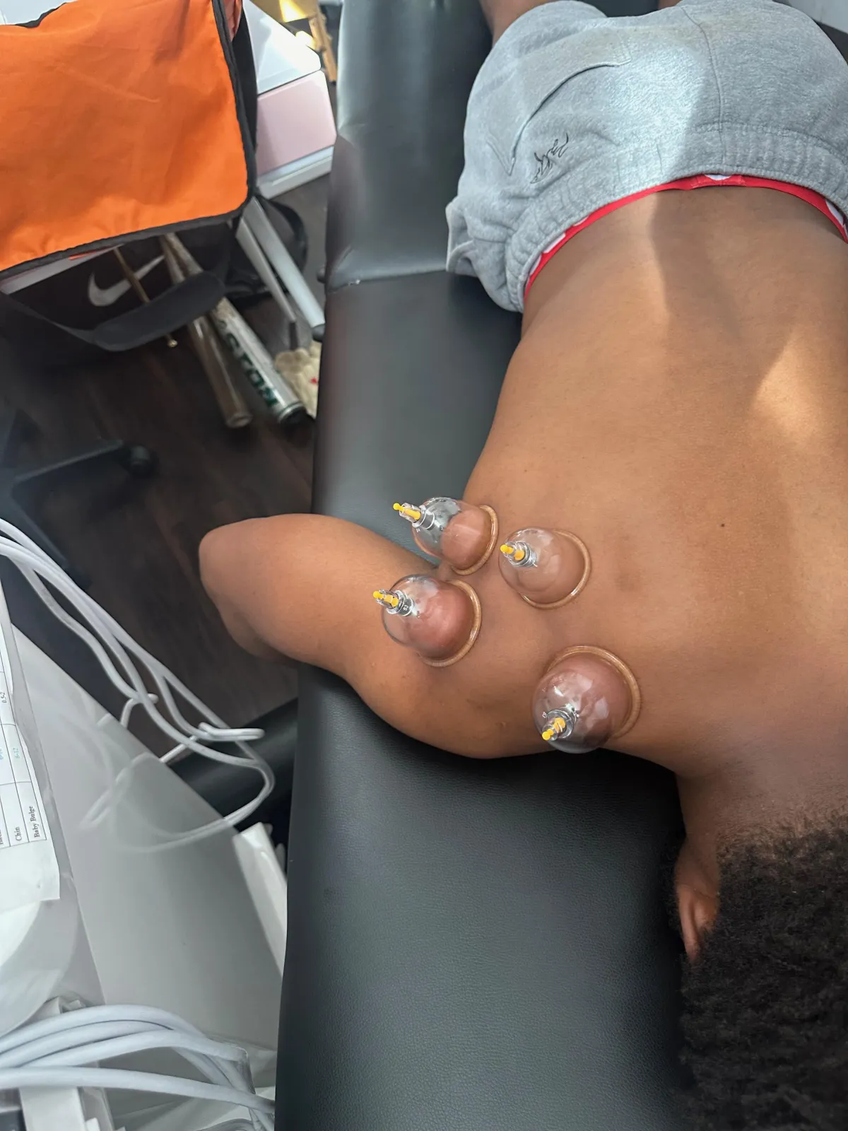 Athlete on treatment table during personalized cupping session for the shoulder