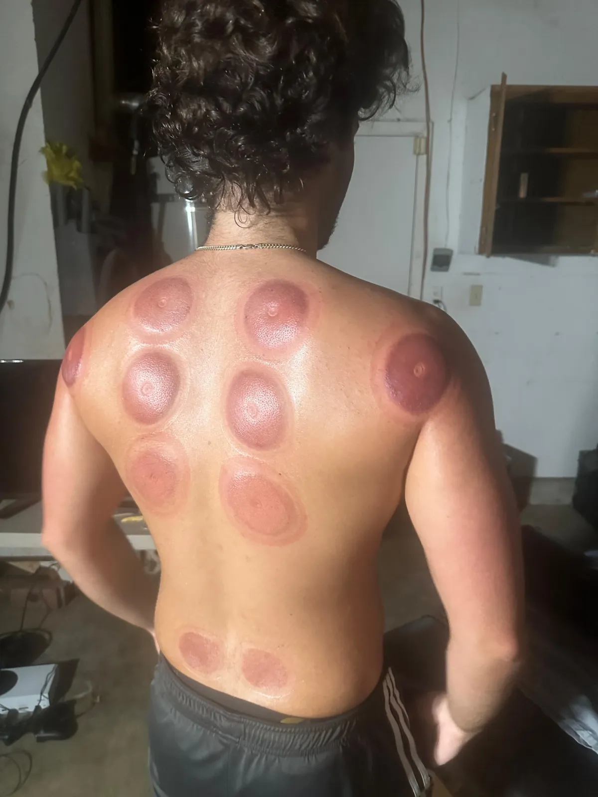back showing cupping therapy marks after athletic recovery treatment