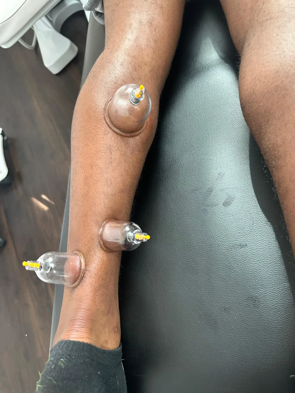 Leg cupping therapy to improve circulation and athletic performance