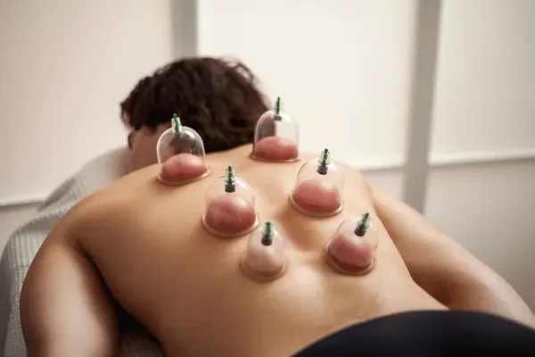cupping therapy on the back to boost circulation and speed up recovery