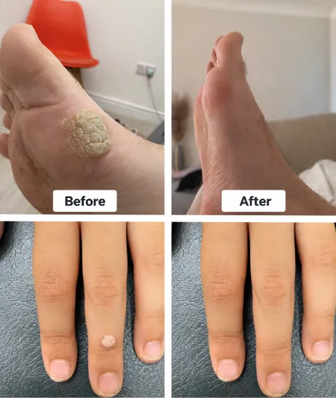 SWIFT Therapy Before and After