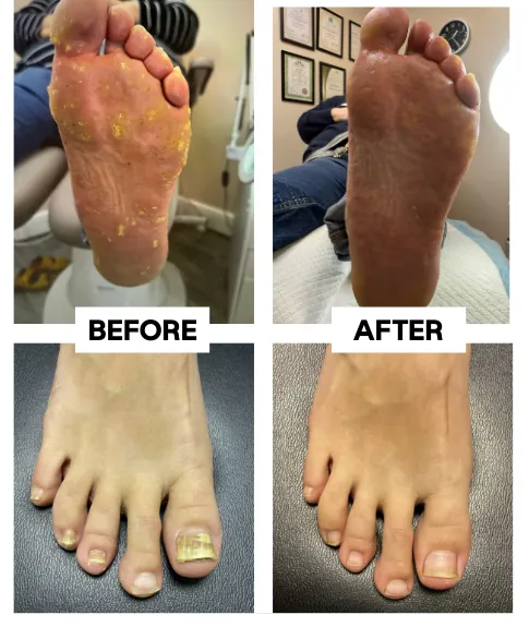 ROUTINE Footcare Before and After