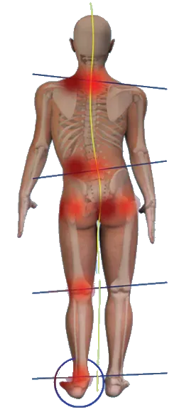 Limb Length Discrepancy