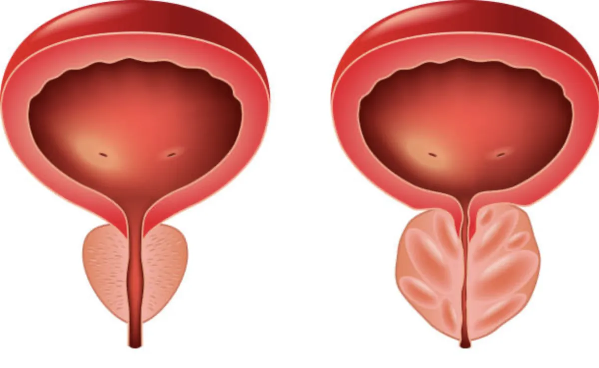 Prostat İyileştirme