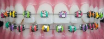 Traditional metal braces with colored bands by Celina Texas dentist at Open Late Dental and Orthodontics