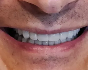 Veneers result by Celina Texas dentist at Open Late Dental and Orthodontics – close-up of a confident smile