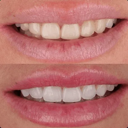 Before and After | All-White Teeth Whitening Marietta GA