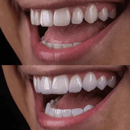 Before and After | All-White Teeth Whitening Marietta GA