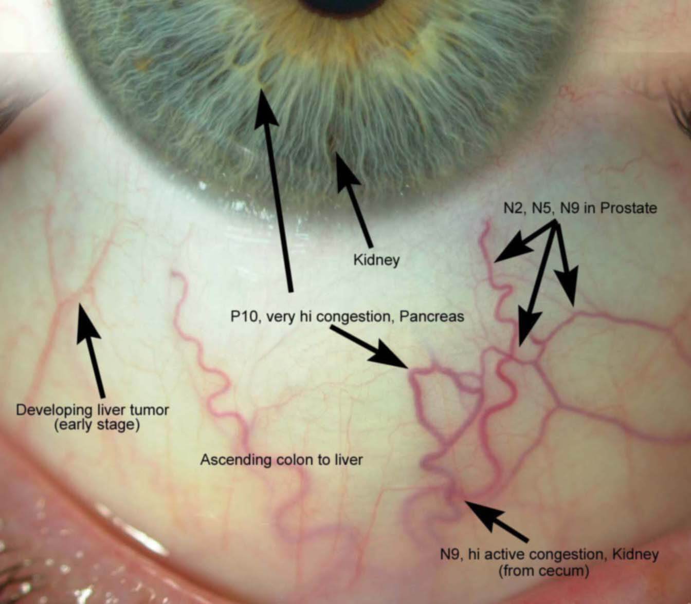 Sclera reading with prostate issues