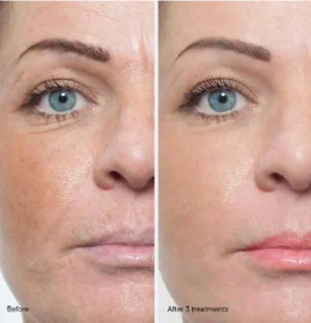 Anti-Aging Collagen producing wrinkle free clear skin micro-needling, stem cell therapy, near me, Villa Rica, Ga, Beauty Social, Villa Rica Ink 