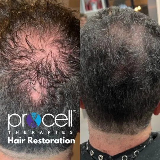 Anti-Aging Collagen producing, hair restoration, hair regrowth, new hair growth,  micro-needling, stem cell therapy, near me, Villa Rica, Ga, Beauty Social, Villa Rica Ink 