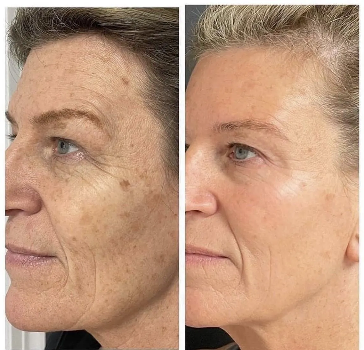 Anti-Aging Collagen producing wrinkle free clear skin micro-needling, stem cell therapy, near me, Villa Rica, Ga, Beauty Social, Villa Rica Ink 
