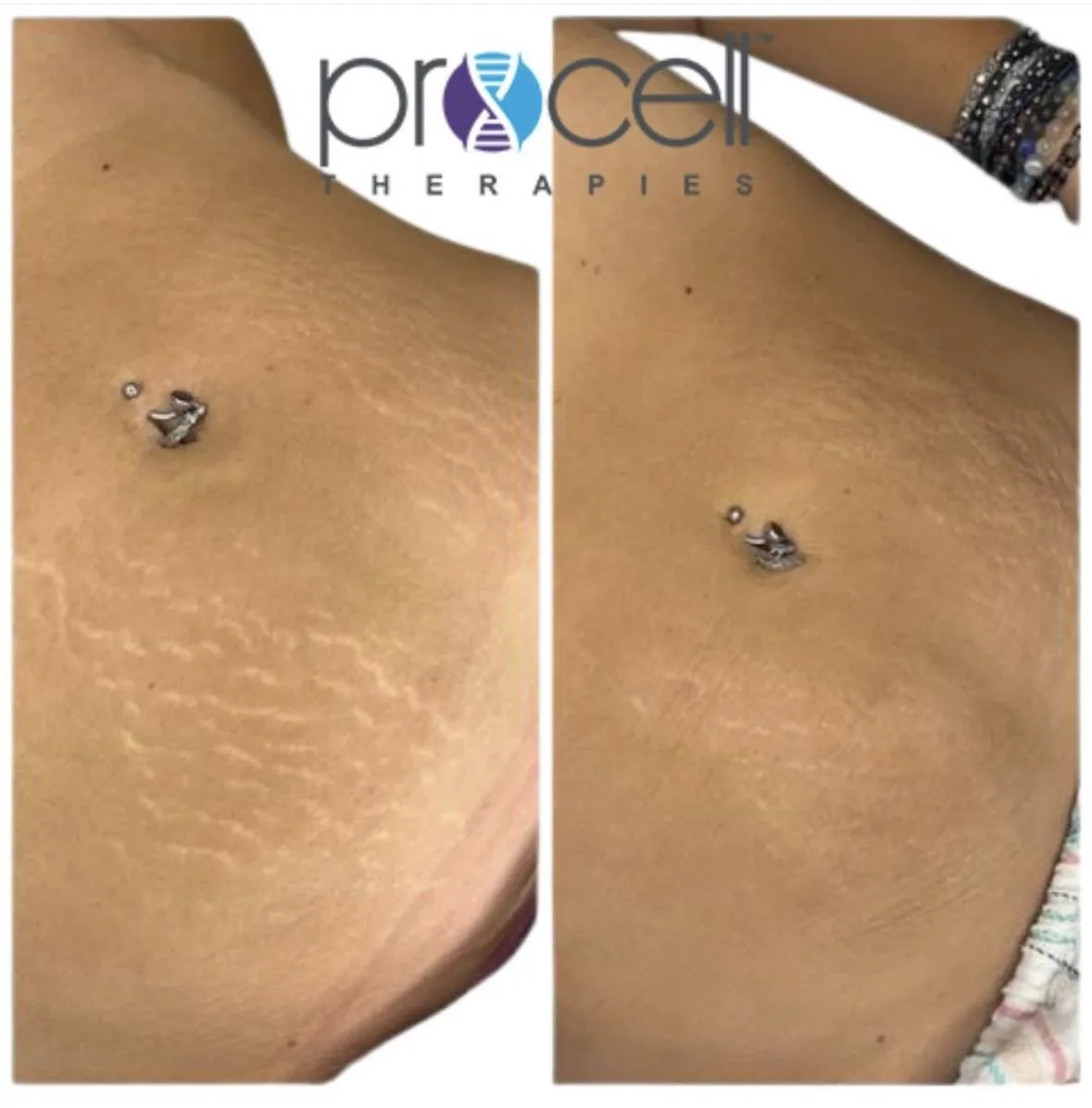 Fine lines, wrinkles, scarring, stretch marks, skin healing, Mico-channeling, Procell therapy in Villa Rica, Ga, Villa Rica Ink, Beauty Social by VRI