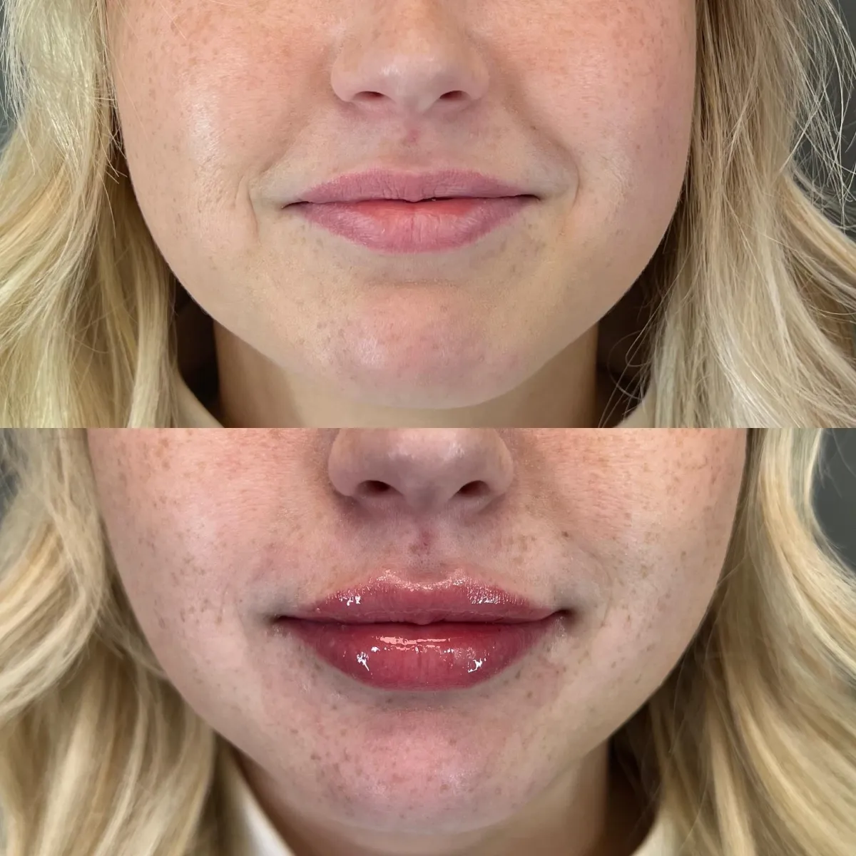 Before and after lip filler results at Lift Plastic Surgery & Med Spa in Houston, showing fuller, more defined lips with a natural, balanced enhancement.