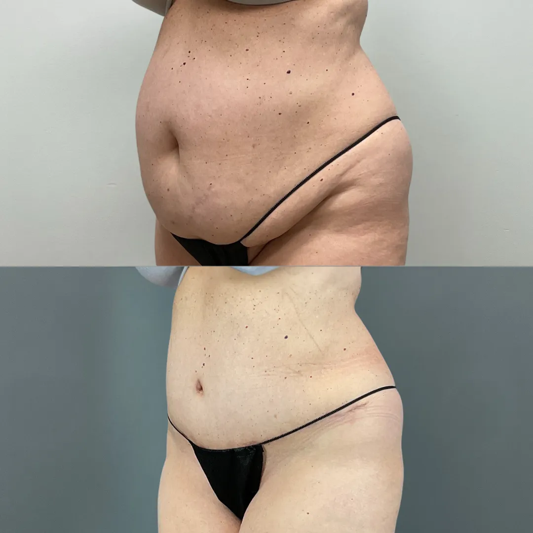 Before and after tummy tuck results at Lift Plastic Surgery in Houston, showing a flatter, tighter abdomen with enhanced contour.