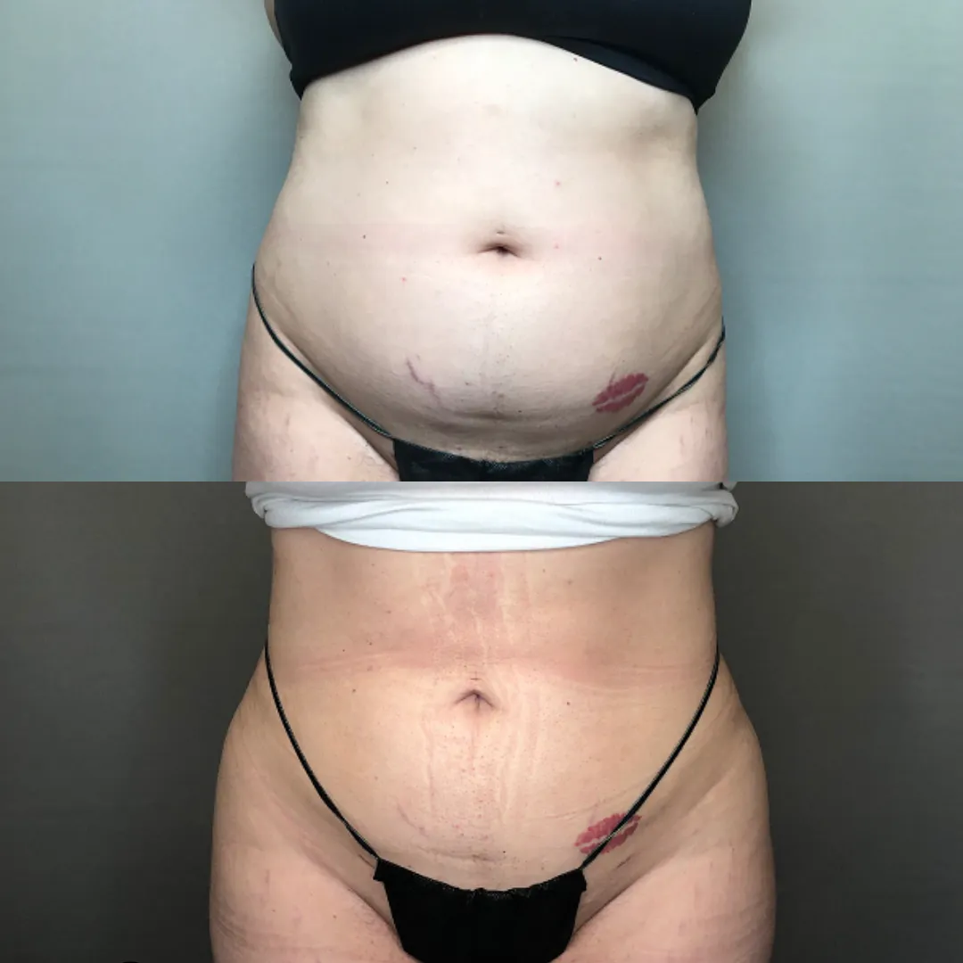 Liposuction before and after results at Lift Plastic Surgery in Houston, highlighting fat reduction and improved body definition for a sculpted physique.