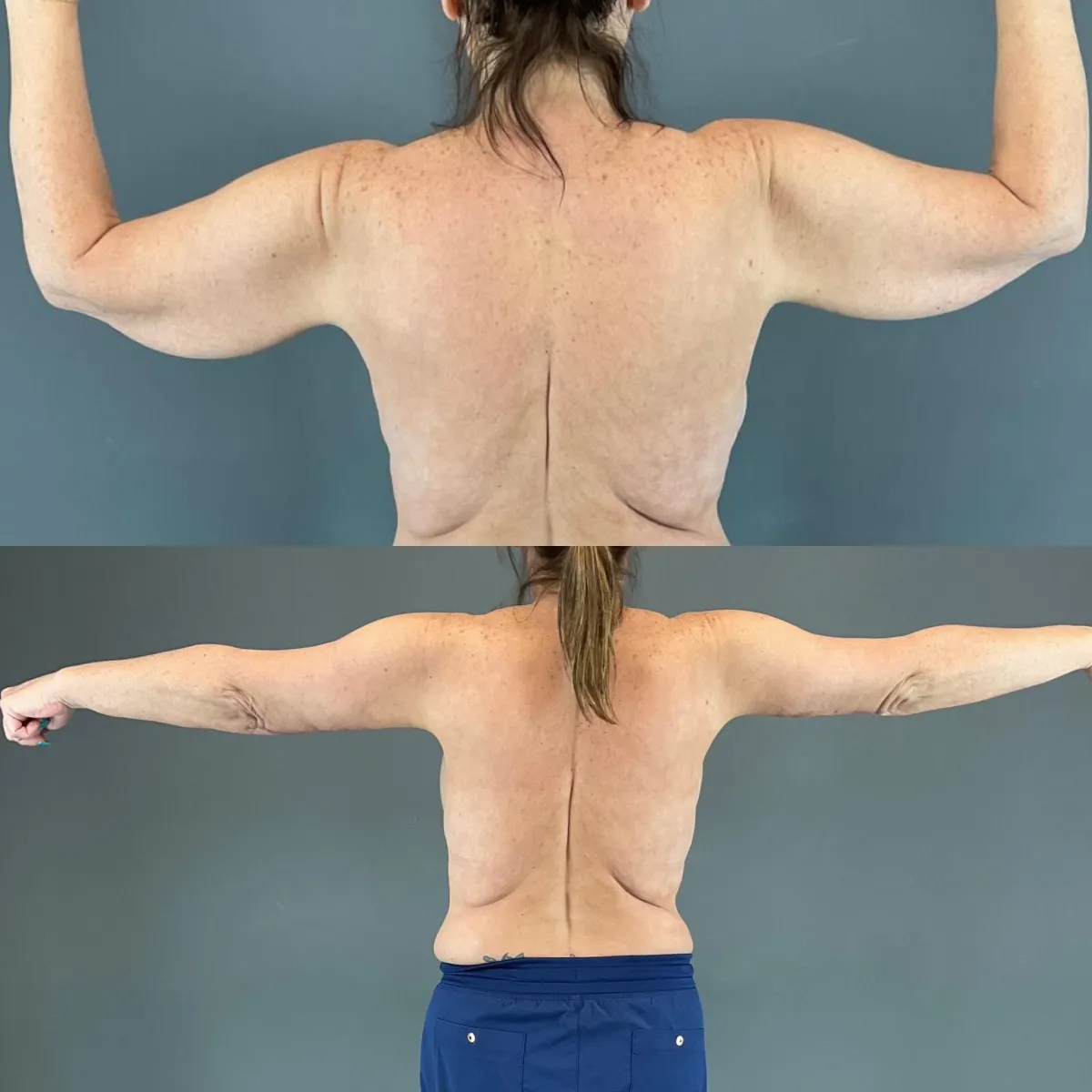 Arm lift before and after results at Lift Plastic Surgery in Houston, demonstrating firmer, more youthful contours with tightened skin.