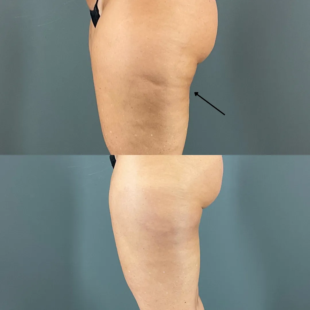 Before and after IPL photofacial treatment on the chest at Lift Med Spa in Houston, showing reduced sun damage, age spots, and improved skin tone.