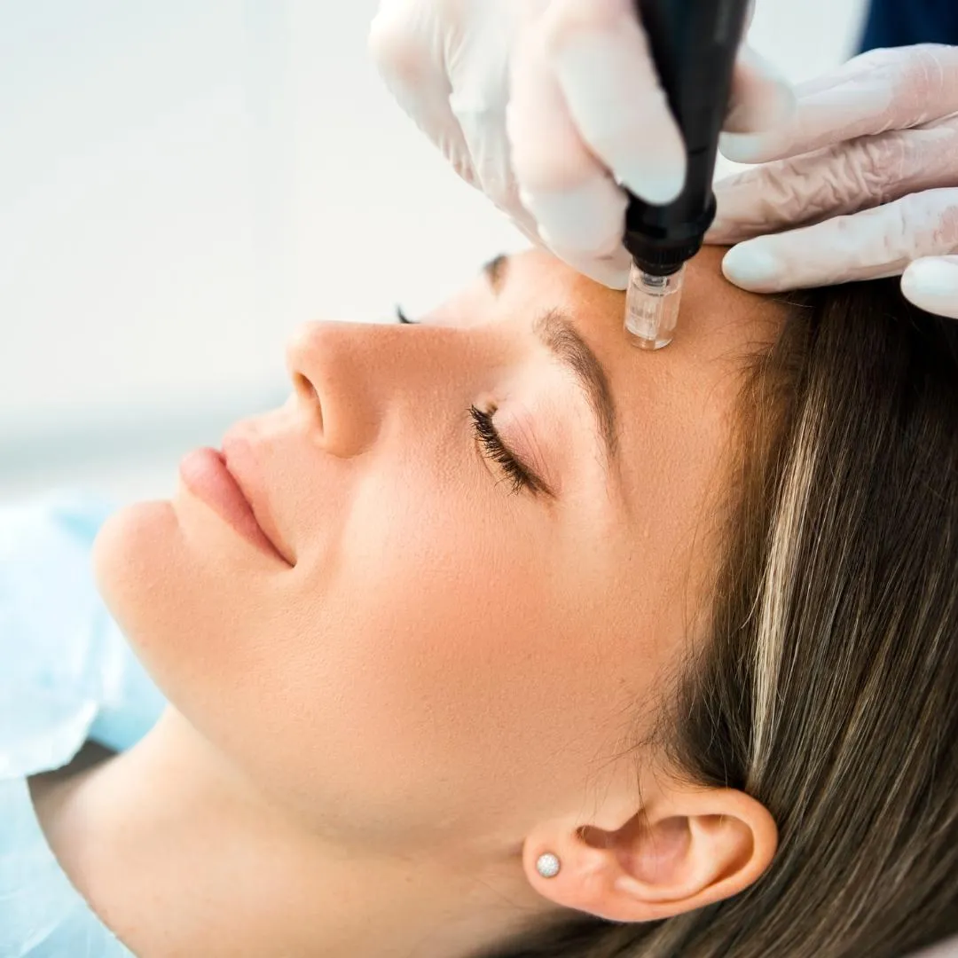 microeedling procedure being performed on a client