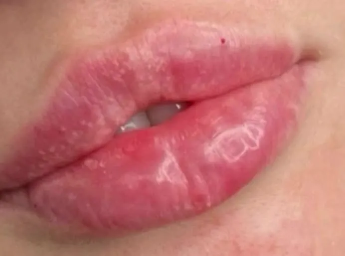Close-up of lips in Star Aesthetics’ original lip filler reel.