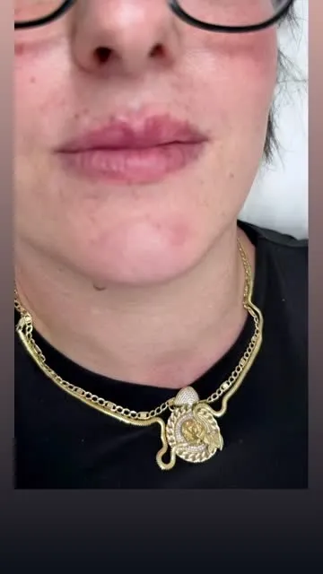 Lip Filler Recovery: Planning Beyond the Appointment