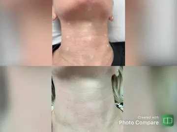 Neck Skin Concerns: What to Discuss at a Consultation