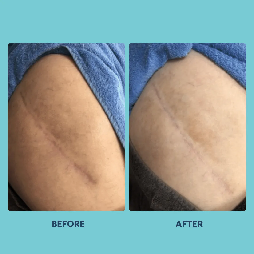 Scar before and after example