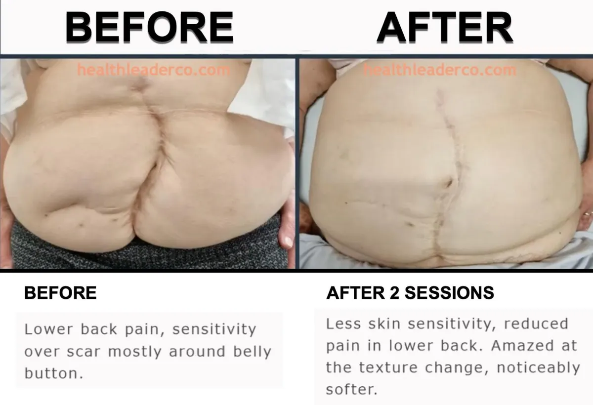 Amazing scar treatment example - before and after