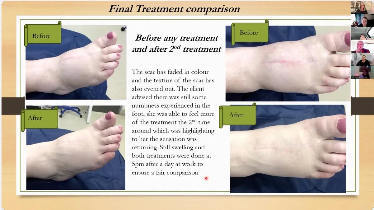 Scar treatment helping arm abduction ROM