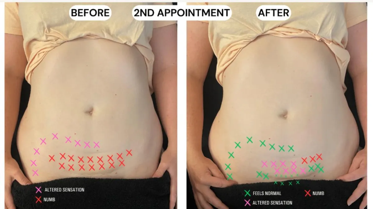 Before and After - showing improved sensitivity and reduced numbness