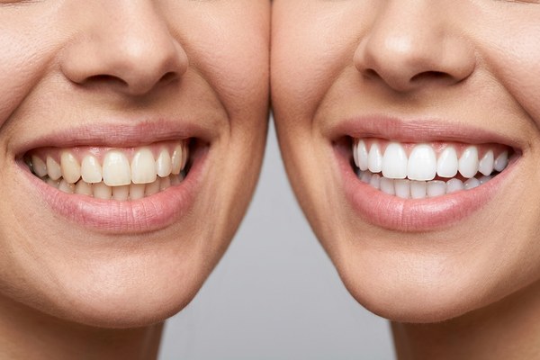 Composite Bonding vs Porcelain Veneers: Which Is the Right Choice for You?
