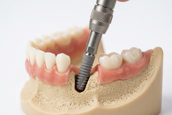 How Much Do Dental Implants Cost in Altrincham? What You Need to Know