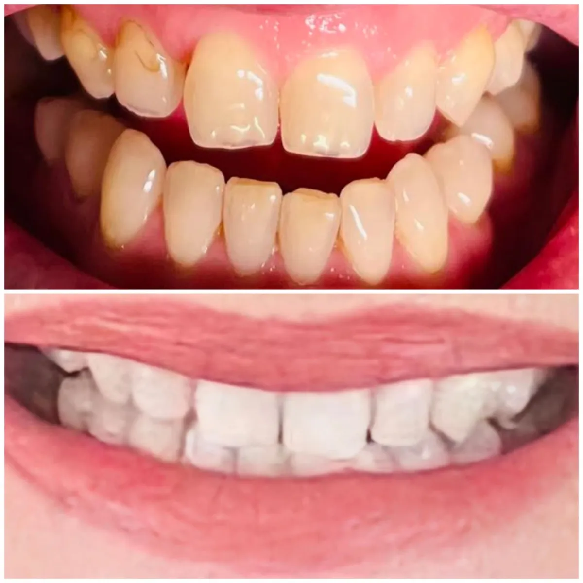 Teeth Whitening Services Caboolture